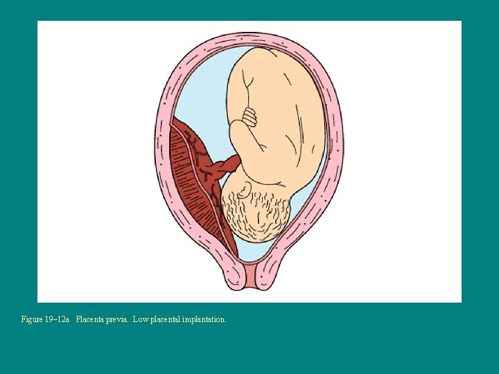 Figure 19– 12 a Placenta previa. Low placental implantation. 
