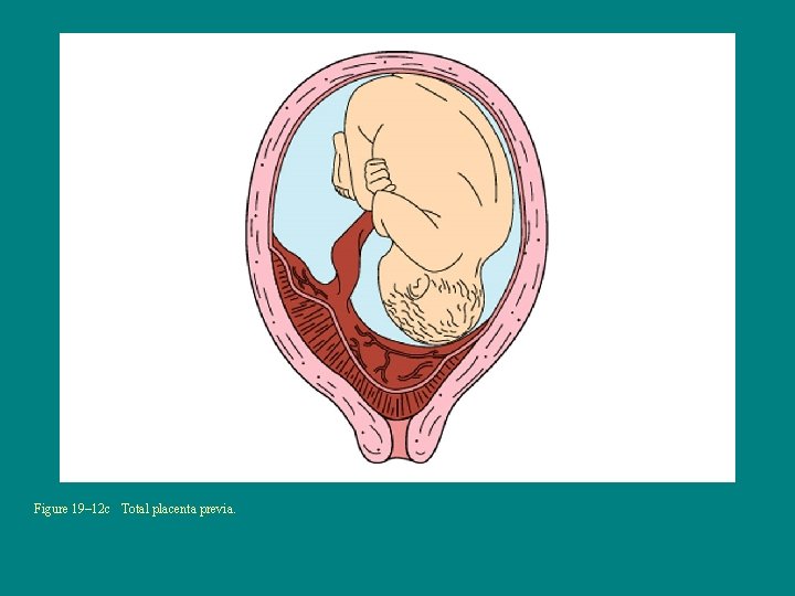 Figure 19– 12 c Total placenta previa. 