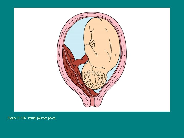 Figure 19– 12 b Partial placenta previa. 