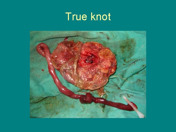 True knot 