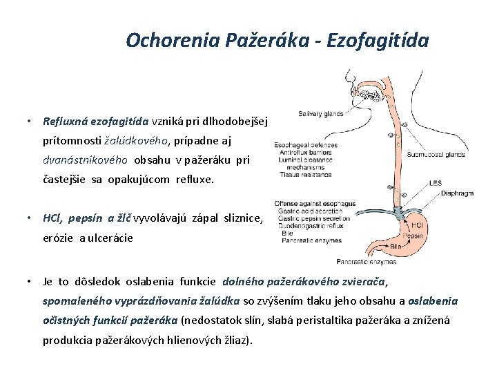 Ochorenia Pažeráka - Ezofagitída • Refluxná ezofagitída vzniká pri dlhodobejšej prítomnosti žalúdkového, prípadne aj