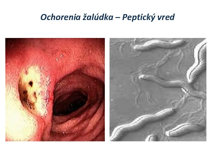 Ochorenia žalúdka – Peptický vred 