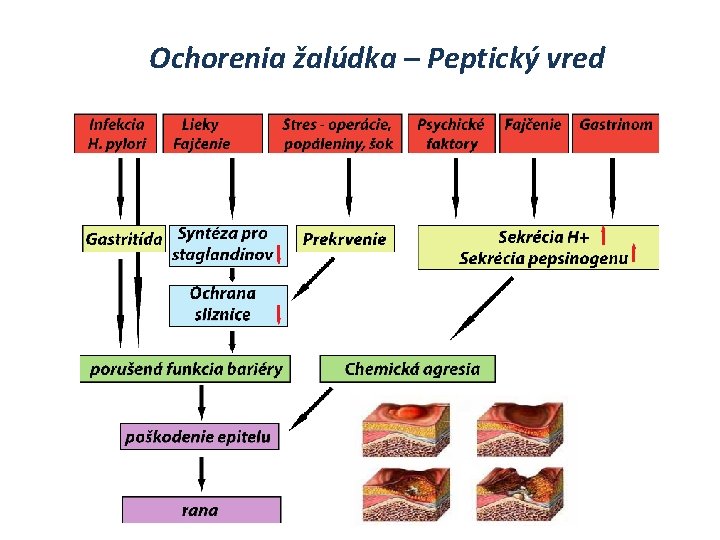 Ochorenia žalúdka – Peptický vred 