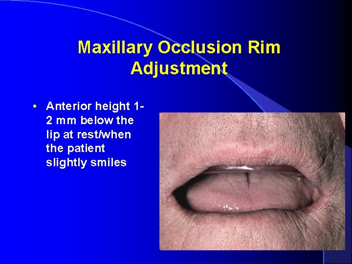 MaxilloMandibular Relationships Occlusal Vertical Dimension And Hinge Axis