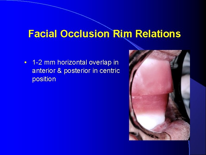 MaxilloMandibular Relationships Occlusal Vertical Dimension And Hinge Axis