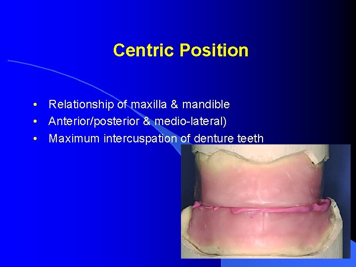 Centric Position • Relationship of maxilla & mandible • Anterior/posterior & medio-lateral) • Maximum