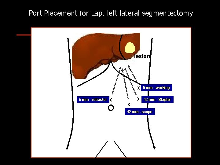 Port Placement for Lap. left lateral segmentectomy lesion X 5 mm - working 5