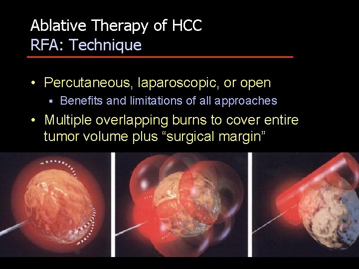 Ablative Therapy of HCC RFA: Technique • Percutaneous, laparoscopic, or open § Benefits and