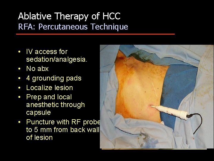 Ablative Therapy of HCC RFA: Percutaneous Technique • IV access for sedation/analgesia. • No