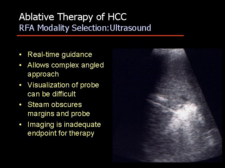 Ablative Therapy of HCC RFA Modality Selection: Ultrasound • Real-time guidance • Allows complex