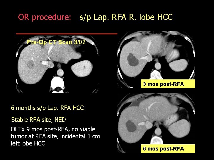 OR procedure: s/p Lap. RFA R. lobe HCC Pre-Op CT Scan 3/02 3 mos