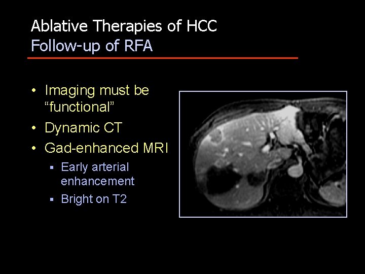 Ablative Therapies of HCC Follow-up of RFA • Imaging must be “functional” • Dynamic