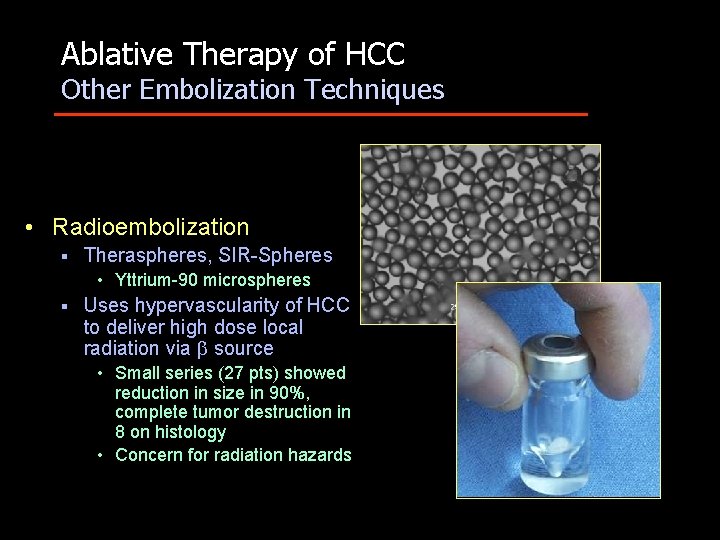 Ablative Therapy of HCC Other Embolization Techniques • Radioembolization § Theraspheres, SIR-Spheres • Yttrium-90