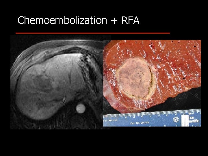 Chemoembolization + RFA 