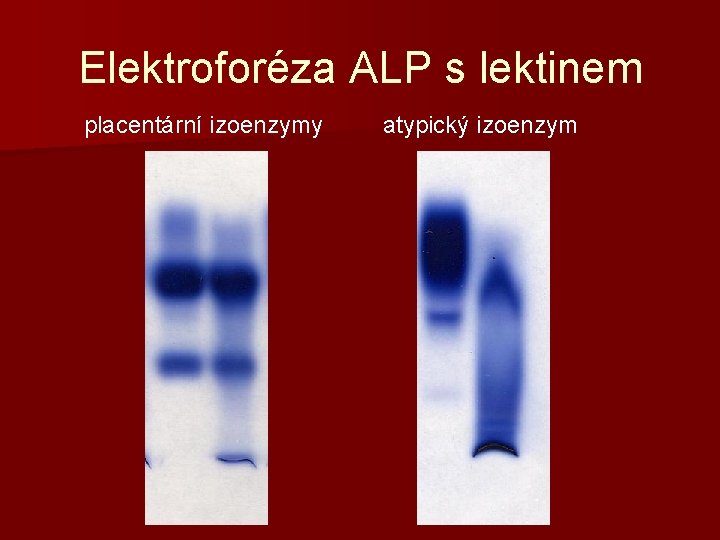 Elektroforéza ALP s lektinem placentární izoenzymy atypický izoenzym 