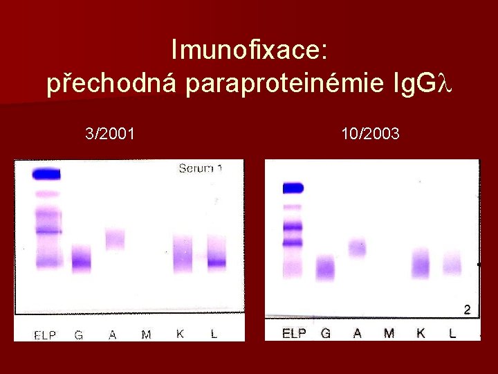 Imunofixace: přechodná paraproteinémie Ig. Gl 3/2001 10/2003 