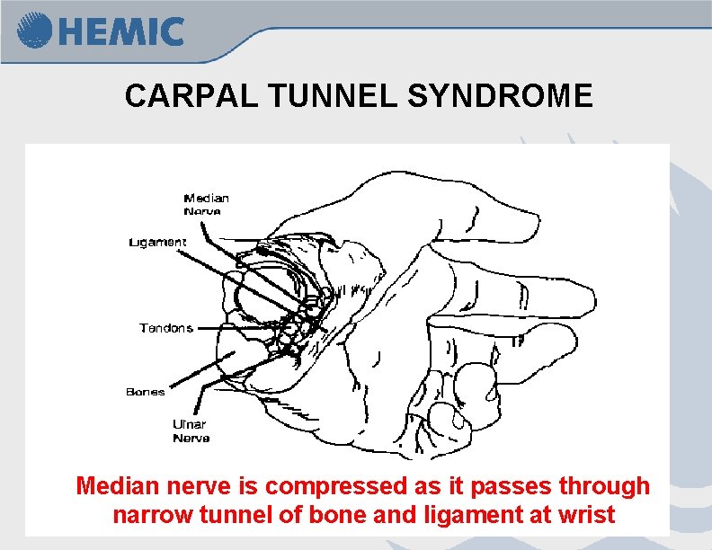 CARPAL TUNNEL SYNDROME Median nerve is compressed as it passes through narrow tunnel of