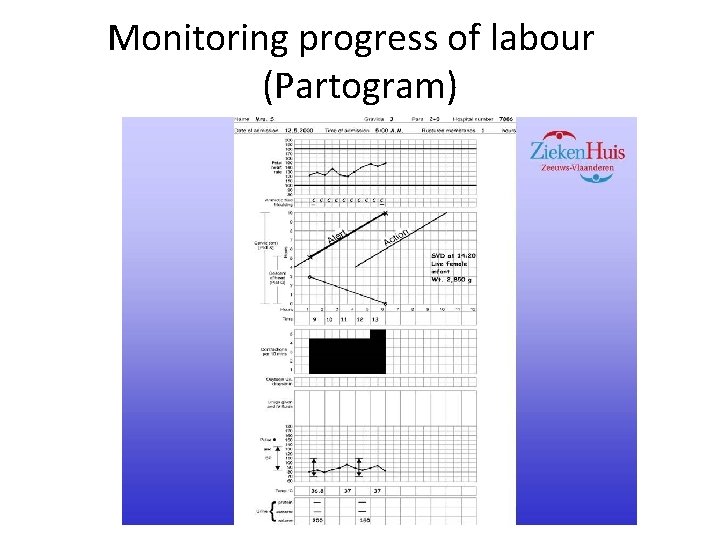 Monitoring progress of labour (Partogram) 