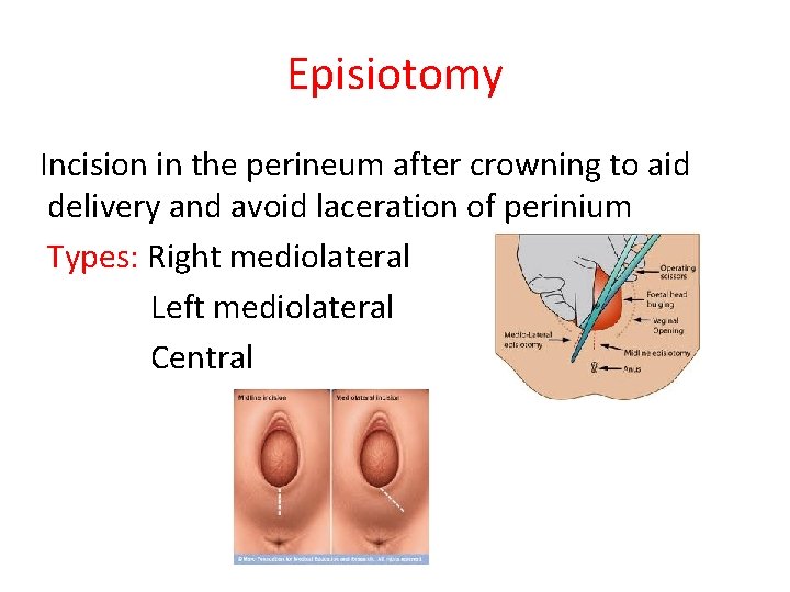 Episiotomy Incision in the perineum after crowning to aid delivery and avoid laceration of