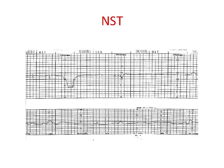 NST 