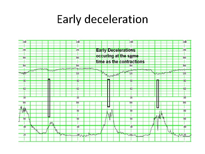 Early deceleration 