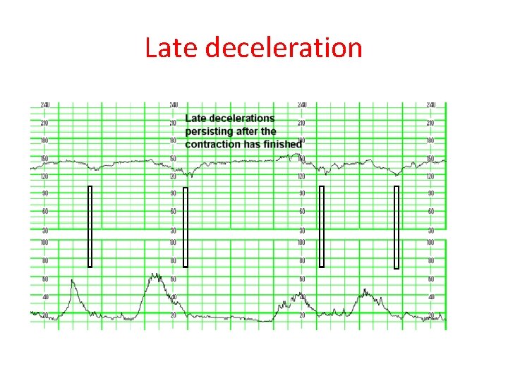 Late deceleration 