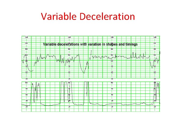 Variable Deceleration 
