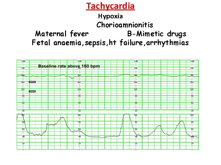 Tachycardia Hypoxia Chorioamnionitis Maternal fever B-Mimetic drugs Fetal anaemia, sepsis, ht failure, arrhythmias 
