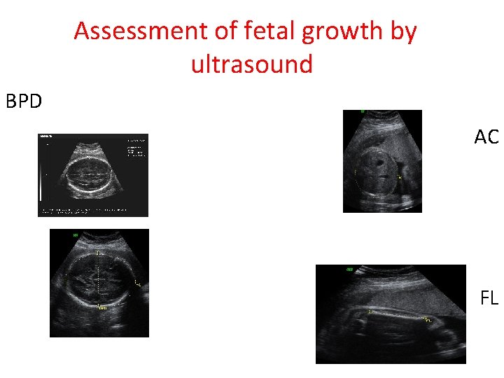 Assessment of fetal growth by ultrasound BPD AC FL 