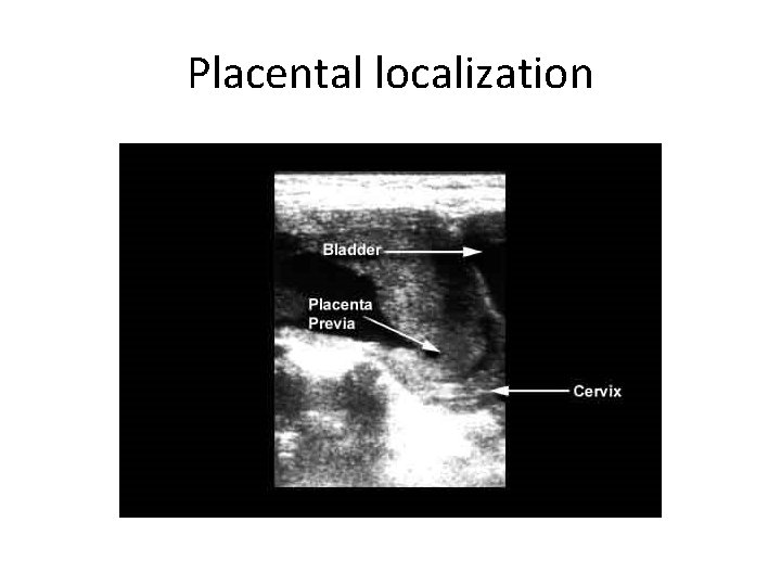 Placental localization 