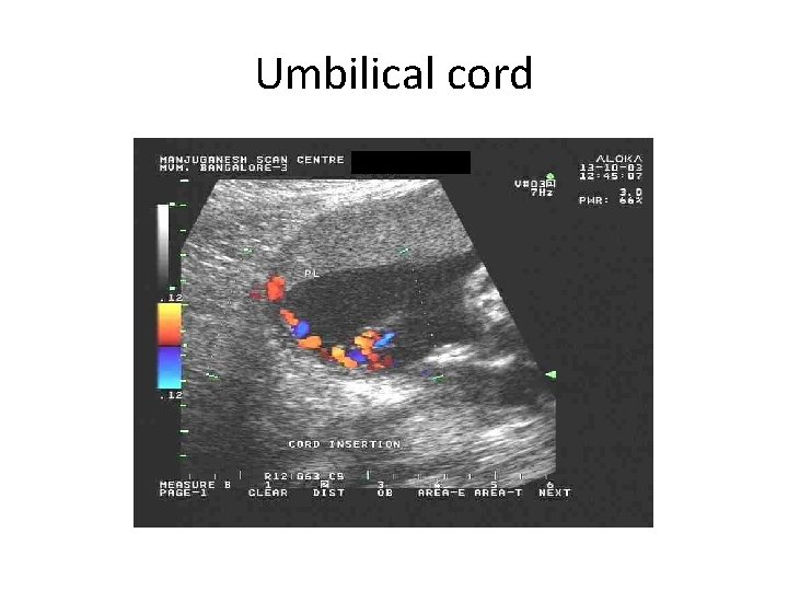 Umbilical cord 