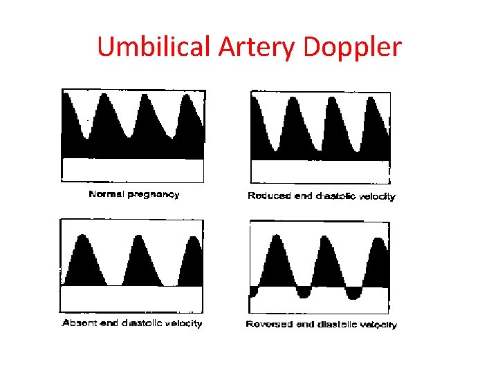 Umbilical Artery Doppler 