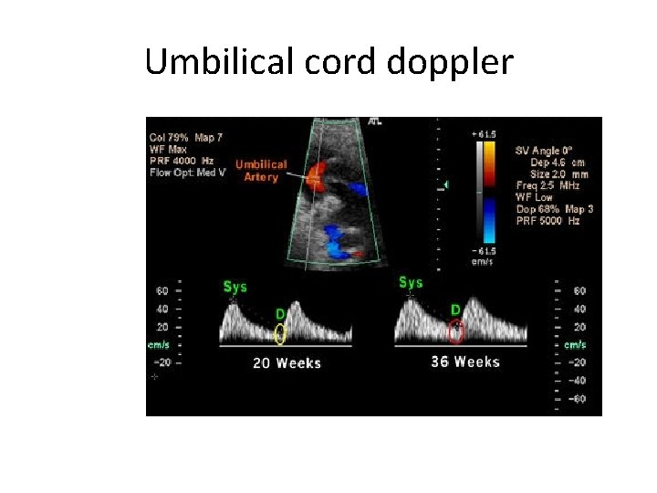 Umbilical cord doppler 
