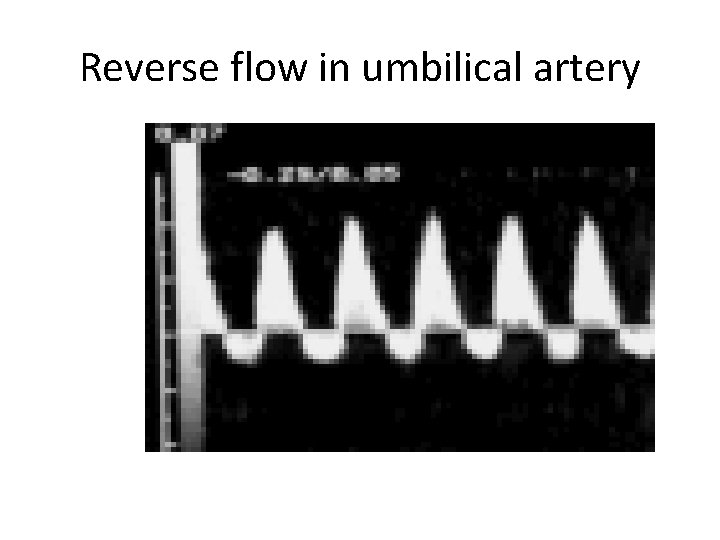 Reverse flow in umbilical artery 