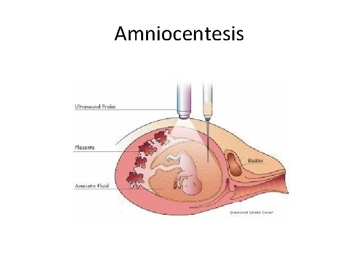 Amniocentesis 