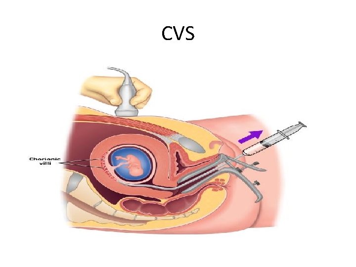 CVS 