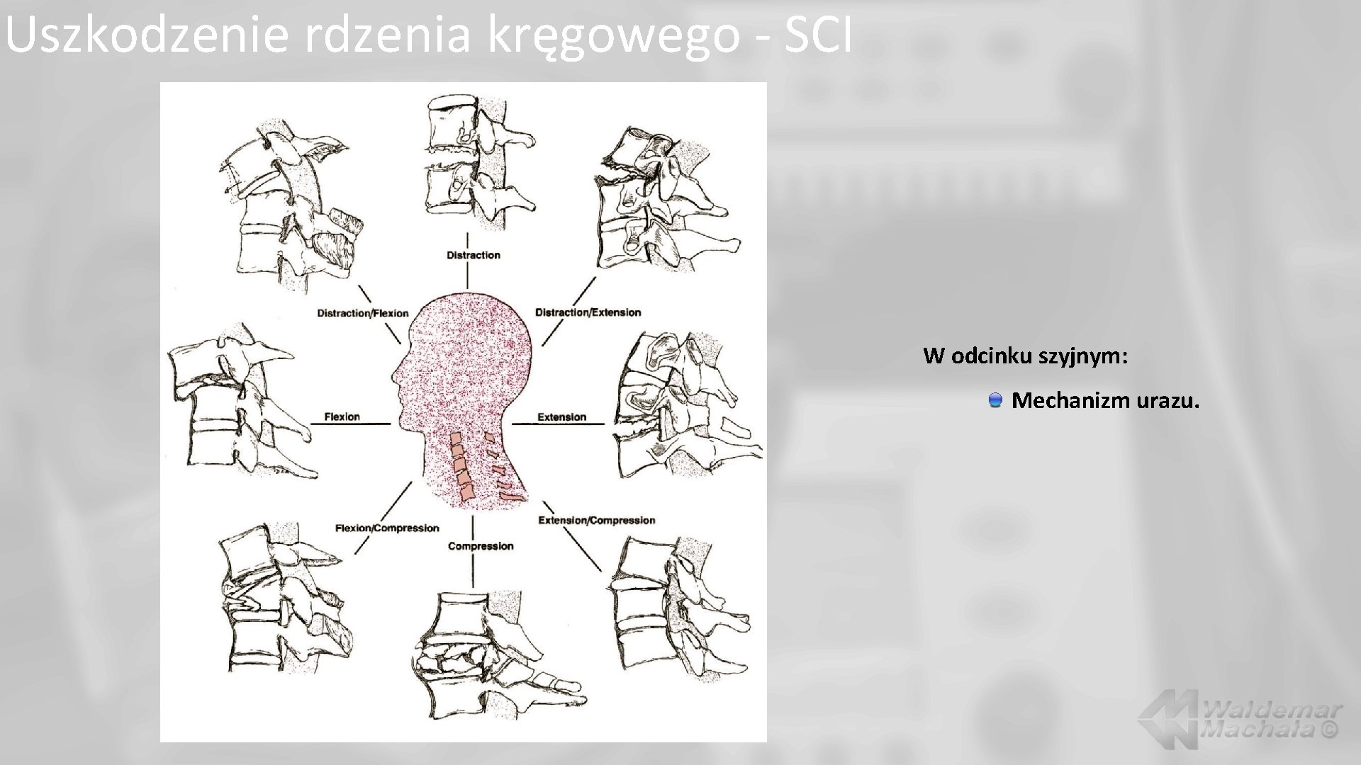 Uszkodzenie rdzenia kręgowego - SCI W odcinku szyjnym: Mechanizm urazu. 