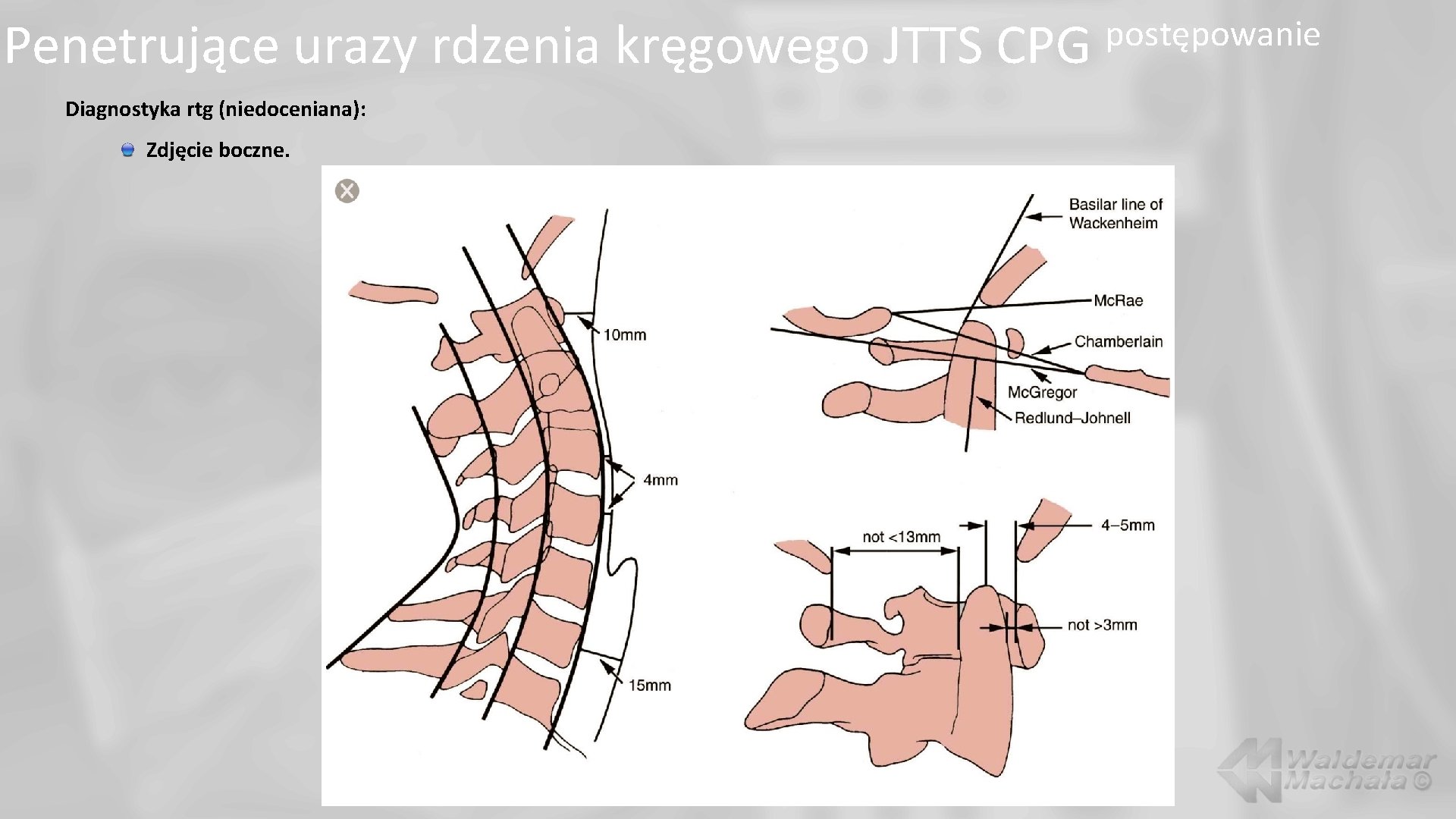 Penetrujące urazy rdzenia kręgowego JTTS CPG Diagnostyka rtg (niedoceniana): Zdjęcie boczne. postępowanie 