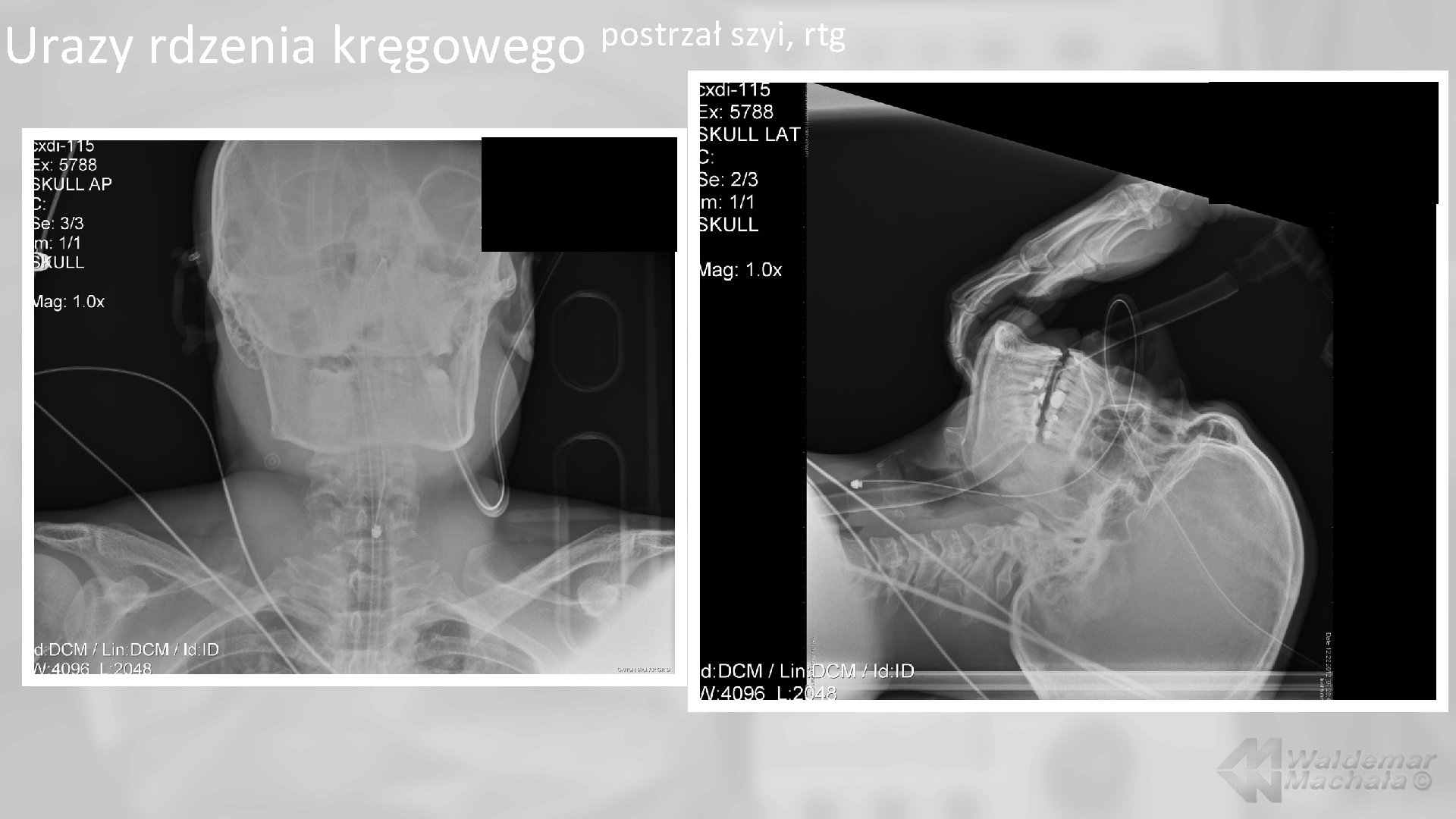 Urazy rdzenia kręgowego postrzał szyi, rtg 