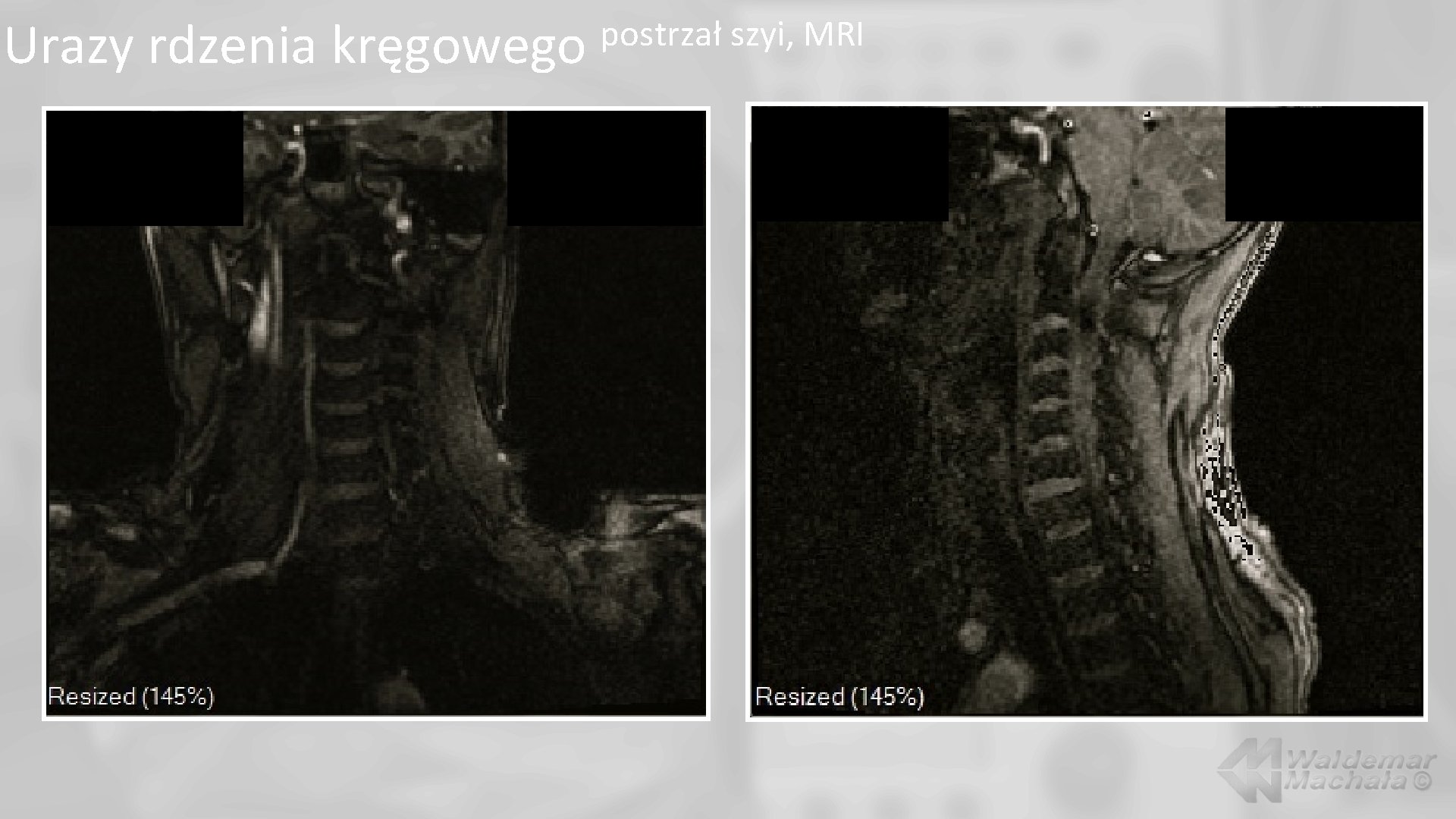 Urazy rdzenia kręgowego postrzał szyi, MRI 