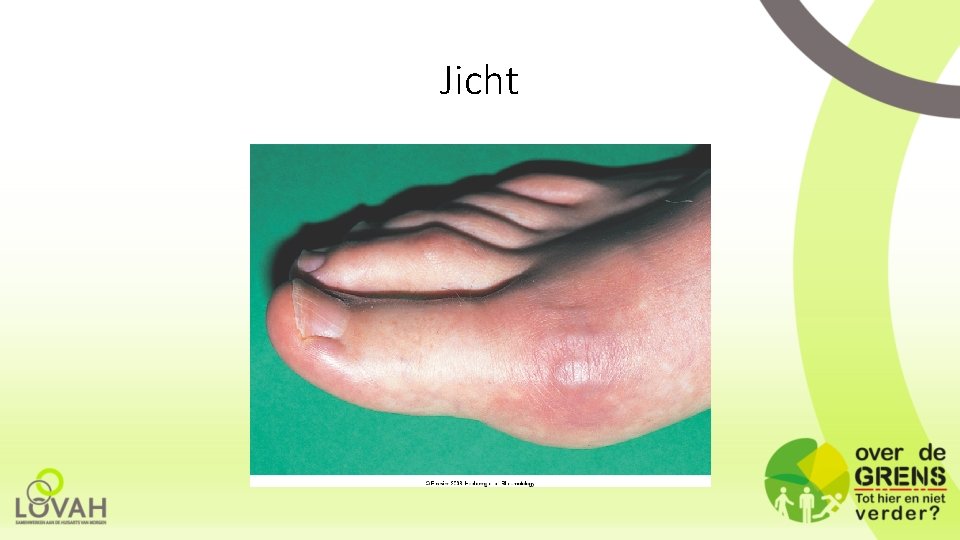 Jicht 