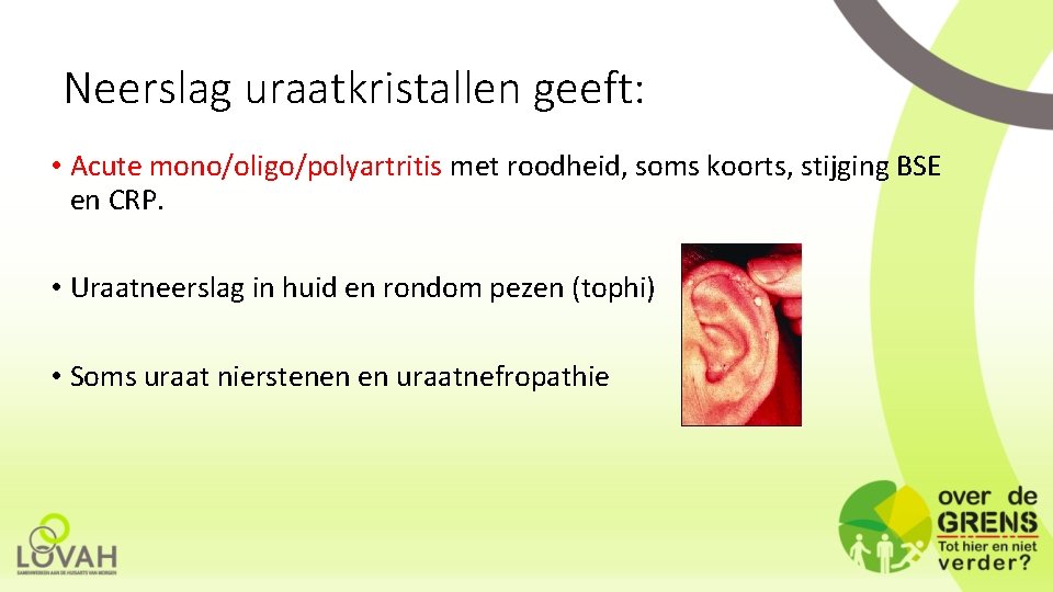 Neerslag uraatkristallen geeft: • Acute mono/oligo/polyartritis met roodheid, soms koorts, stijging BSE en CRP.