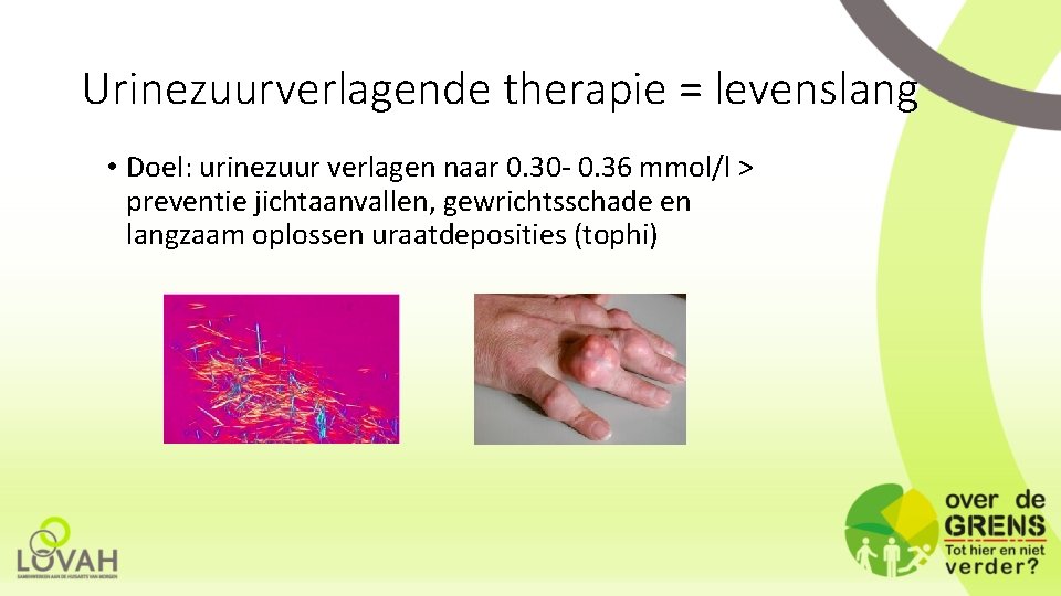 Urinezuurverlagende therapie = levenslang • Doel: urinezuur verlagen naar 0. 30 - 0. 36