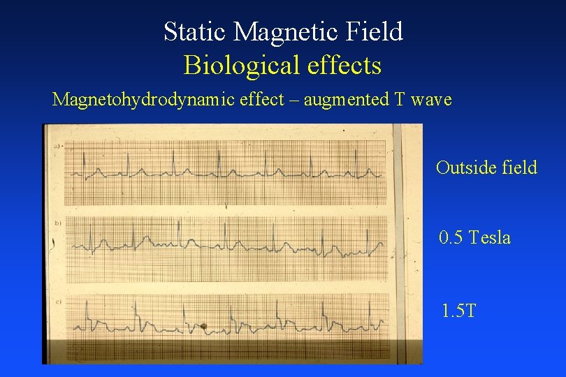 Static Magnetic Field Biological effects Magnetohydrodynamic effect – augmented T wave Outside field 0.
