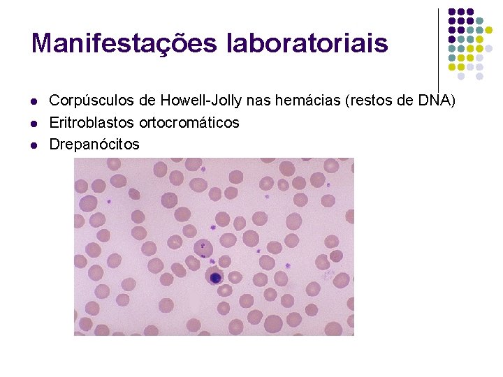 Manifestações laboratoriais l l l Corpúsculos de Howell-Jolly nas hemácias (restos de DNA) Eritroblastos