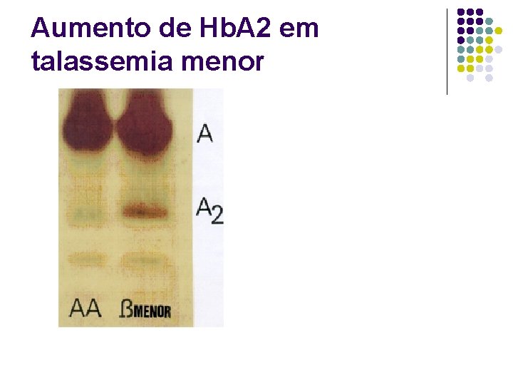 Aumento de Hb. A 2 em talassemia menor 