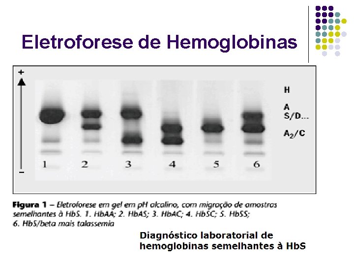 Eletroforese de Hemoglobinas 