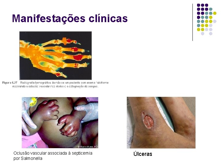 Manifestações clínicas Oclusão vascular associada à septicemia por Salmonella Úlceras 