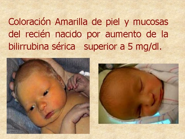 Coloración Amarilla de piel y mucosas del recién nacido por aumento de la bilirrubina
