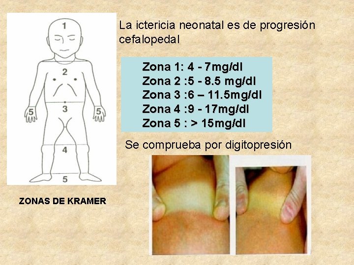 La ictericia neonatal es de progresión cefalopedal Zona 1: 4 - 7 mg/dl Zona